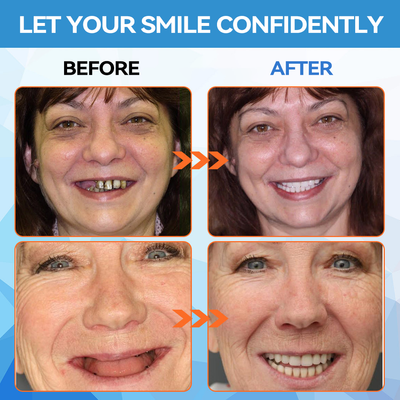 DentaLock Reline Kit - Make Your Loose Dentures Fit Like New - 50% OFF