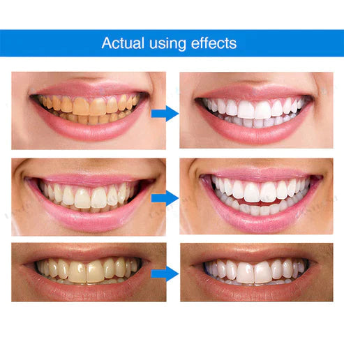 1 + 1 FREE - Ivory™ Teeth Whitening Essence