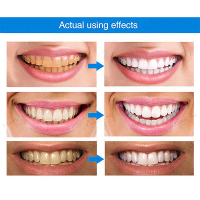 1 + 1 FREE - Ivory™ Teeth Whitening Essence
