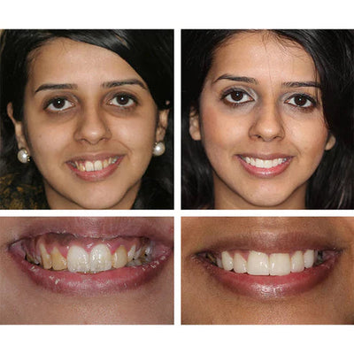 1 + 1 FREE - Ivory™ Teeth Whitening Essence