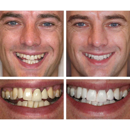 1 + 1 FREE - Ivory™ Teeth Whitening Essence