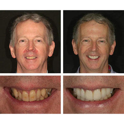 1 + 1 FREE - Ivory™ Teeth Whitening Essence
