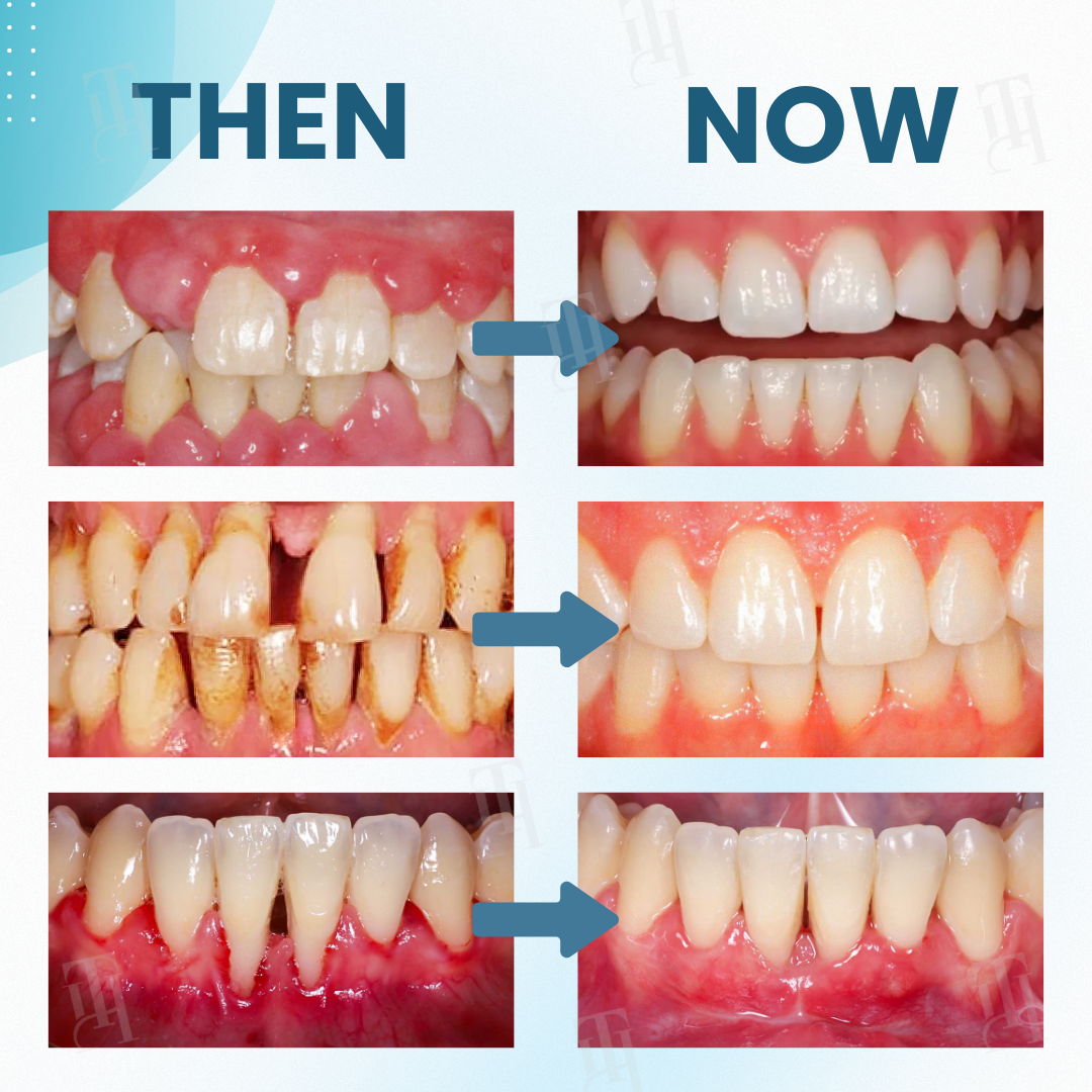 AEXZR Makesmile Powder - Stronger Teeth & Gums + 50% OFF