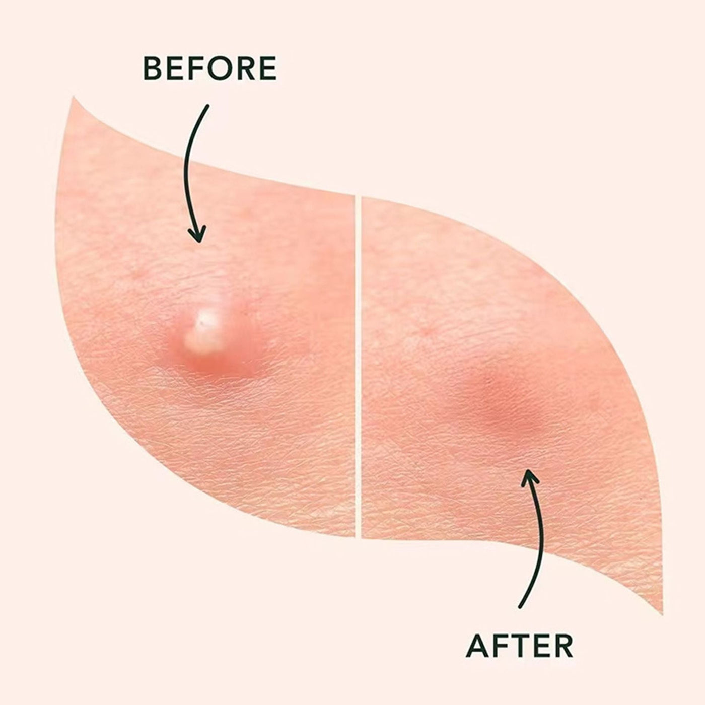 The Star Pimple Patches - Shrink Zits & Look Cute + 50% OFF