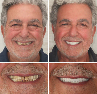 NaturaFit Dentures - The No-Slip, Custom-Fit Smile + 50% OFF